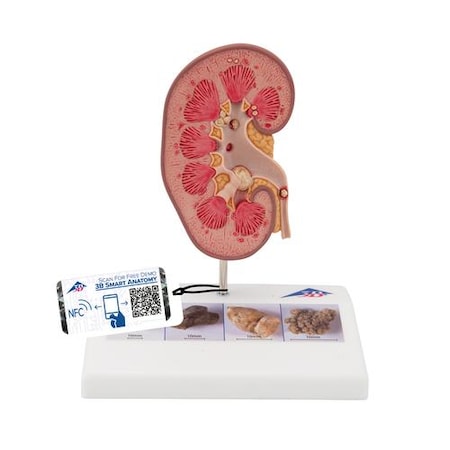 Kidney Stone Model - W/ 3B Smart Anatomy